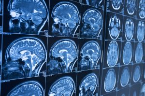 CTE After Northeast Philadelphia, PA Traumatic Brain Injuries