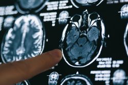 Can MRI and CT Scans Fail to Detect Traumatic Brain Injury?