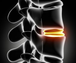 Herniated Disk Injuries in Pennsylvania