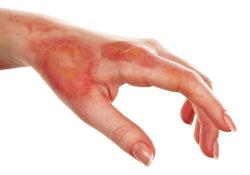 Common Types of Burn Accidents in Pennsylvania