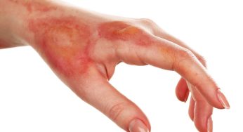 Burn Injury Accidents and Painful Consequences for Pennsylvania Victims